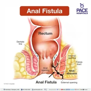 Read more about the article What is Fistula