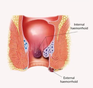 Read more about the article What is Piles ?